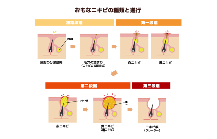 【毛穴治療・黒ずみ】ニキビの種類と特徴