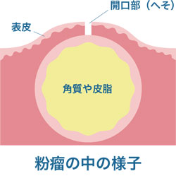 粉瘤内の様子