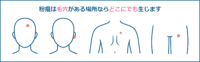 粉瘤の発症場所