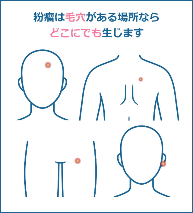 粉瘤の発症場所
