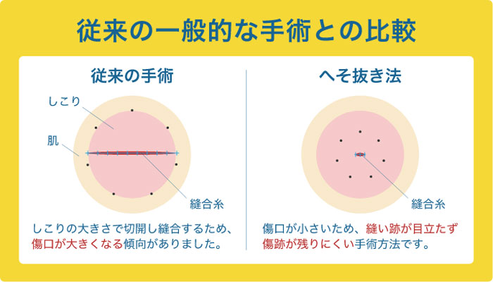 粉瘤の従来の一般的な手術との比較