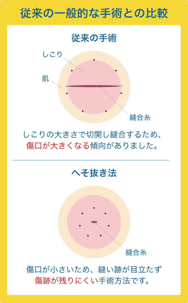 粉瘤の従来の一般的な手術との比較