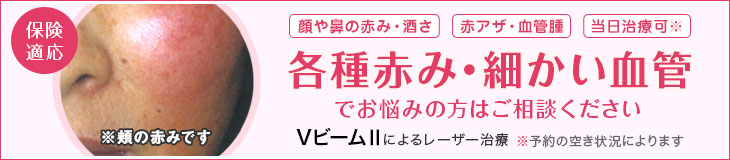 ＶビームⅡによるレーザー治療 各種赤み・細かい血管でお悩みの方はご相談ください。 [保険適用]